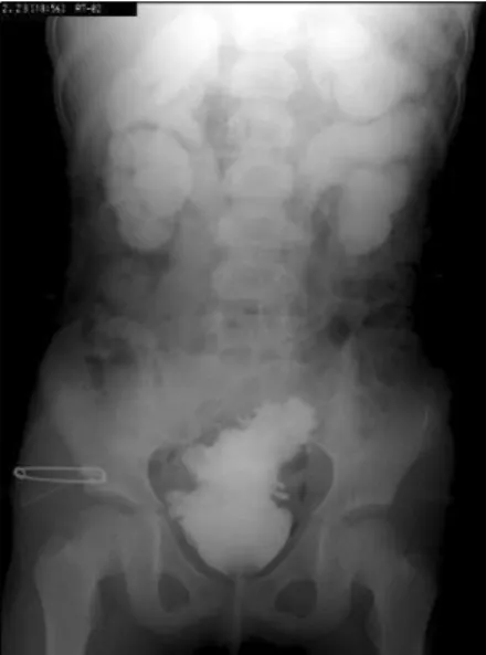 Fig.  1.  Typical  voiding  cystourethrogram  of  the  Hinman  syndrome.tional  voiding)  등을 보이는 것이 특징이다.1-3  그리고 대부분의 환자에서 요로계통의 영상의학 이상 소견이 동반되면서 어떤 이유에서인지 방광을 비우는 데 문제를 보인다