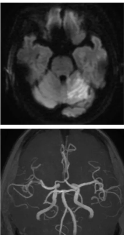 Fig. 1. A subject’s cerebellar infarction on diffusion  weighted image(top) and MRA(bottom).
