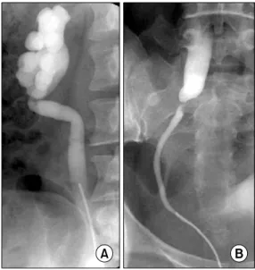 Fig.  1.  Retrograde  pyelography  shows  abrupt  luminal  narrowing  at  the  mid-ureter  with  right  hydroureteronephrosis,  suggesting  ureteral  stricture  rather  than  external  lesion.