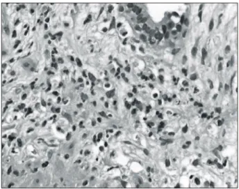 Fig.  2.  (A)  Mild (grade  I)  chronic  prostatic  inflammation.  A  few  mononuclear  lymphoid  cells  are  noted  in  the  periglandular  tissue