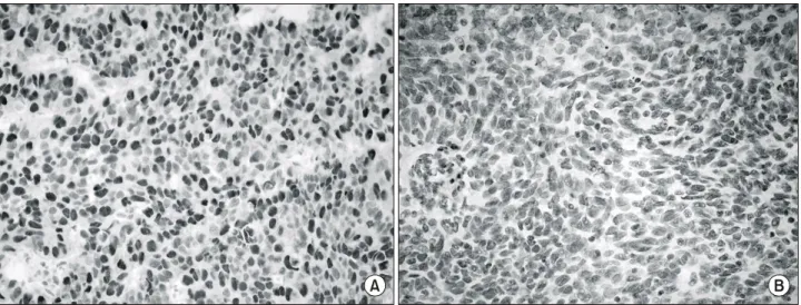 Fig.  1.  Immunohistochemical  staining  for  E2F3  in  bladder  cancer.  (A)  Diffuse  staining  for  E2F3  in  the  nucleus  of  the  tumor  cells (hema- (hema-toxylin  counterstain,  x400)