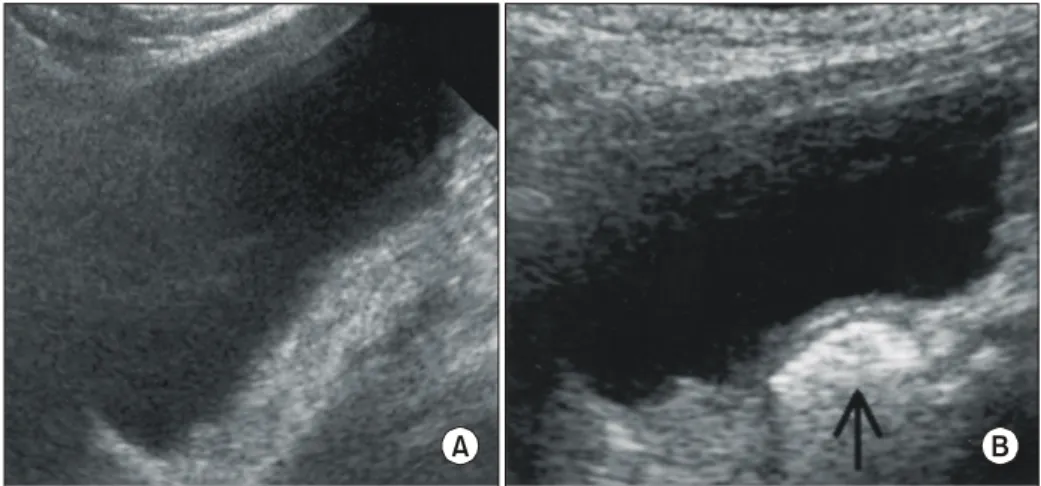 Fig.  1.  Urinary  bladder  sonography. 