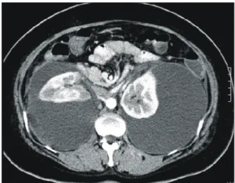 Fig.  1.  Abdominal  computed  tomography (CT)  scan  shows  a  large  fluid  collection  around  both  kidneys
