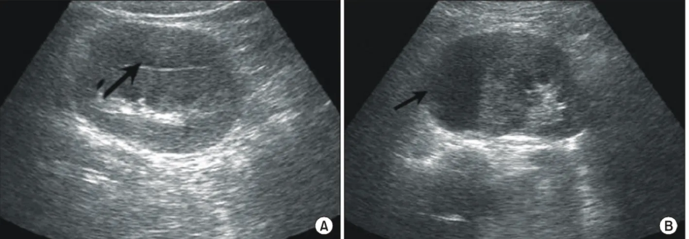 Fig.  3.  Ultrasonography  shows  complete  reabsorption  of  perinephric  urinomas  after  5  months (A:  right  kidney,  B:  left  kidney).