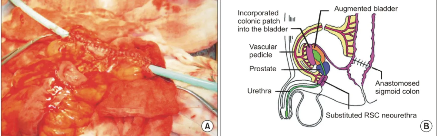 Fig.  3.  Schematic  view  of  Gracilis-Myo-Bladder  Mucosa  flap  (GMBM)  neourethra.
