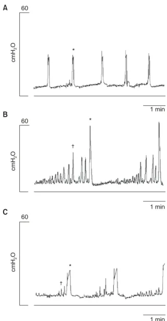 Fig.  1.  Effects  of  intravesical  electrical  stimulation.  Cystometro- Cystometro-gram  after  the  intravesical  instillation  of  saline  in  the  normal  group  (A)  and  the  spinalized  group (B)