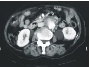 Fig.  1.  Computed  tomography (CT)  scan  demonstrates  bilateral  ureteral  dilatation  and  aneurysm  of  the  abdominal  aorta  with  hyperdense  enhanced  soft  tissue  at  the  aortic  wall.