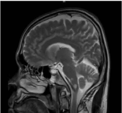 Fig. 1. Brain MRI (Transverse section) Fig. 2. Brain MRI (Sagittal section)3. 발병일: 2009년 6월 5일4