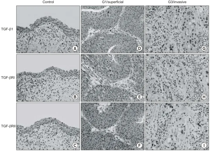 Fig.  4.  Immunostaining  of  TGF-β1,  TGF-βRI  and  TGF-βRII  in  normal  and  cancerous  bladder  tissues