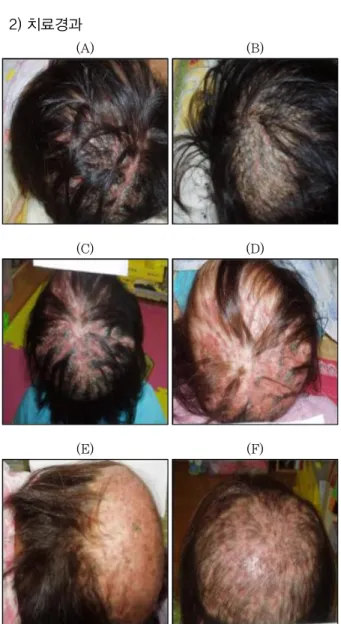 Fig. 1. Treatment for seborrheic dermatitis of the scalp.