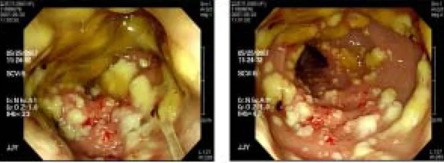Fig. 1. Sigmoid scopy (5/25) 