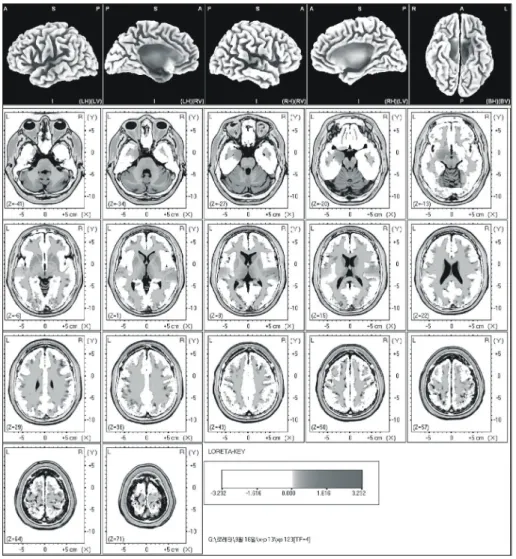 Fig.  1.  The  anatomical  areas  of  current  density  increment  of  the  beta  1 (13-  18Hz)  band  induced  by  visual-sexual  arousal