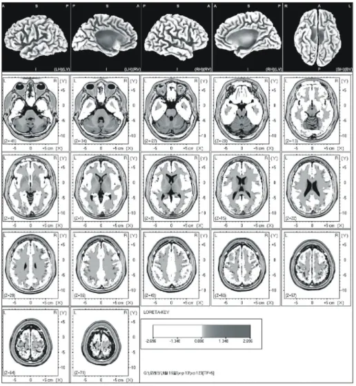 Fig.  2.  The  anatomical  areas  of  current  density  increment  of  the  beta  2 (19-21  Hz)  band  induced  by  visual-sexual   a-rousal