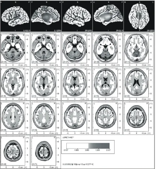 Fig.  3.  The  anatomical  areas  of  current  density  increment  of  the  beta  3 (22-  30Hz)  band  induced  by  visual-sexual  arousal