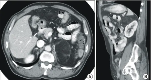 Fig.  3.  Myelolipoma  composed  of  adipose  tissue  and  bone  marrow  elements  that  are  partially  surrounded  by  epithelium  of  adrenal   cor-tex  and  a  fibrous  capsule  (H&amp;E,  x100).
