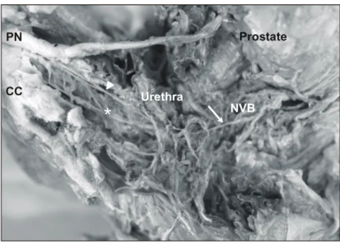 Fig.  3.  Formalin  fixed  cadaver  dissection  showing  the  nerve  course  along  the  urethra  and  rhabdosphincter