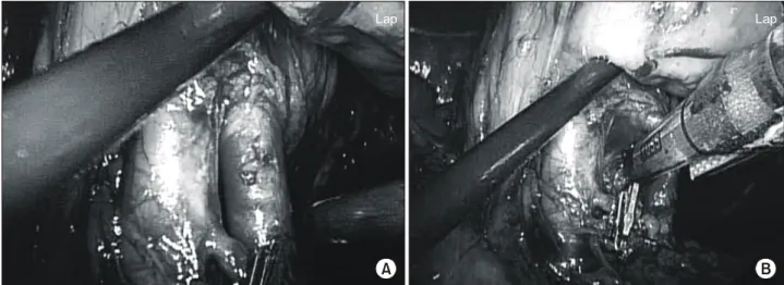 Fig.  1.  Laparoscopic  view  of  renal  hilar  vessels  handling.  (A)  Dissected  left  renal  artery  and  vein  after  the  ligation  and  division  of  the  gonadal  vein,  (B)  renal  artery  ligation  and  division  with  using  a  12-mm  EndoGIA Ⓡ 
