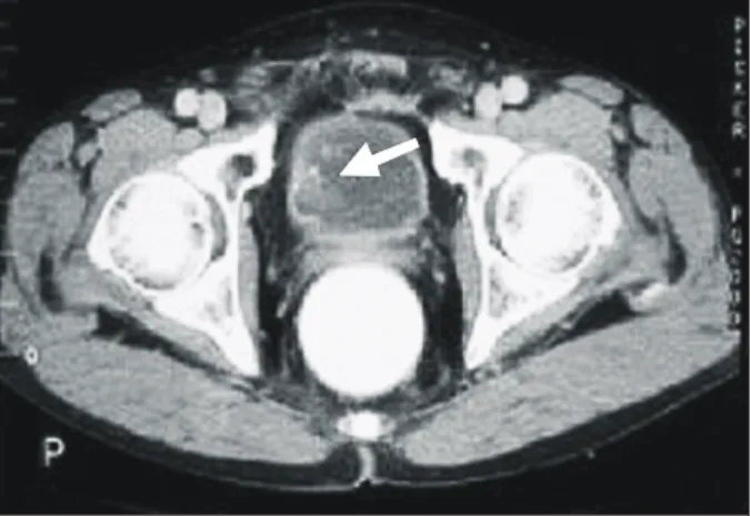 Fig.  3.  Microscopic  finding  shows  well  differentiated  adenocarcinoma  with  tubulopapillary  structure  and  a  mucin  pool (H&amp;E  stain,  x100).