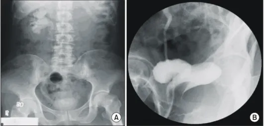 Fig.  1.  (A)  Excretory  urogram  reveals  a  left  nonvisualized  kidney,  right  hydronephrosis,  hydroureter  and  a  small  capacity  bladder