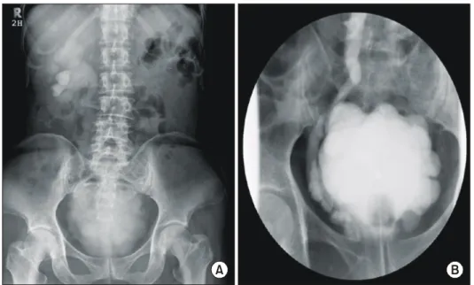 Fig.  3.  The  postoperative  5  month  excretory  urogram (A)  and  voiding  cystourethrogram (B)  showing  right  hydronephrosis  and  vesicoureteral  reflux (GII).
