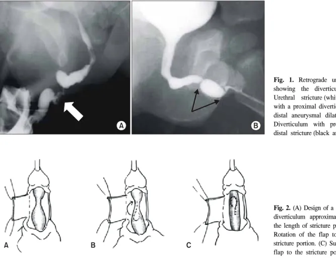 Fig.  1.  Retrograde  urethrogram  showing  the  diverticulum.  (A)  Urethral  stricture (white  arrow)  with  a  proximal  diverticulum  and  distal  aneurysmal  dilatation
