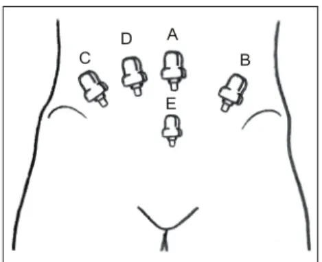 Fig.  4.  Placement  of  the  5  ports  for  the  trocar  in  laparoscopic  radical  prostatectomy.