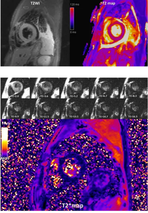 Fig. 17.  Beta-thalassemia in  35-year-old man. Substantial signal  loss occurred at TE of 8.3 ms, and  measured T2* value was 3.8 ms