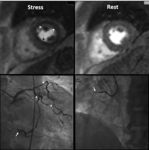 Fig. 2.  Three-vessel disease  in 70-year-old man. Ring-like  subendocardial perfusion defect  (arrowheads) is seen on stress,  and disappears on rest images  (upper row)