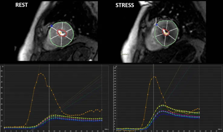 Fig. 7. Example of semi-quantitative perfusion analysis using dedicated software. Regional maximal up-slope values are  demonstrated based on 17-segment model on time-SI profile