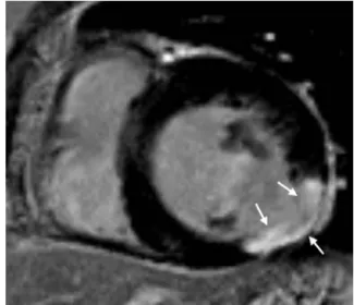 Fig. 8. Role of TI in LGE imaging. Left  image (a) shows wrong nulling of  normal myocardium that is shown to  be darkest at border with higher SI  centrally