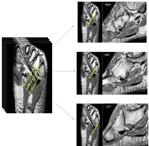 Fig. 1. Differentiation of the three levels of the cuboid groove. The peroneus longus tendon (PL) location and cuboid groove  size are evaluated on the oblique sagittal images of the lateral, middle, and medial levels of the cuboid groove