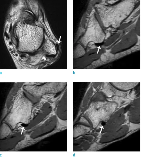 Table 2. Quantitative Peroneus Longus Tendon Location Cuboid groove  level Asymptomatic group Dislocation group P-value Lateral level 6.55 (0.00~12.9) 3.80 (0.00~15.9) 0.152 Middle level 0 (-1.44~11.7) 0 (-5.26~4.90) 0.306 Medial level 0 (-3.79~3.20) 0 (-3