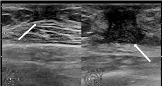 Fig. 2. Follow-up ultrasono- ultrasono-graphic image (a) and color  Doppler scan (b) reveals an  irregular mass of about 4 ×  1.7 cm with a heterogeneous  internal echo pattern in  the left  subareolar-to-central region with internal  vascularity, suggesti