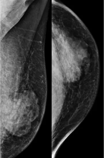 Fig. 4.  Contrast-enhanced CT image reveals a lobulated,  heterogeneous enhancing mass of about 5.3 cm in the left  subareolar-to-central region.