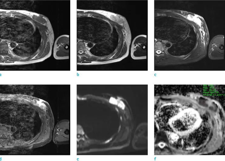 Fig. 6. T1- (a), T2- (b), fat-suppressed T2- (c), and 2 minute delayed gadolinium-enhanced T1-weighted (d) MR images