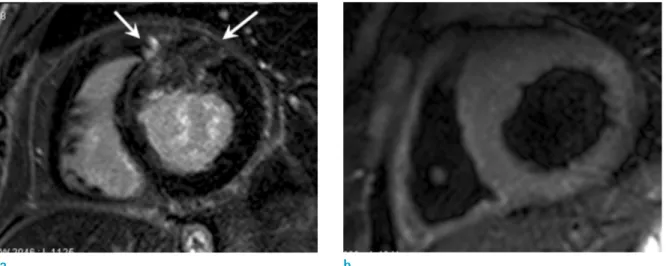 Fig. 7. Dilated cardiomyopathy in a 54-year-old woman  who complained of dyspnea and a progressed heart failure