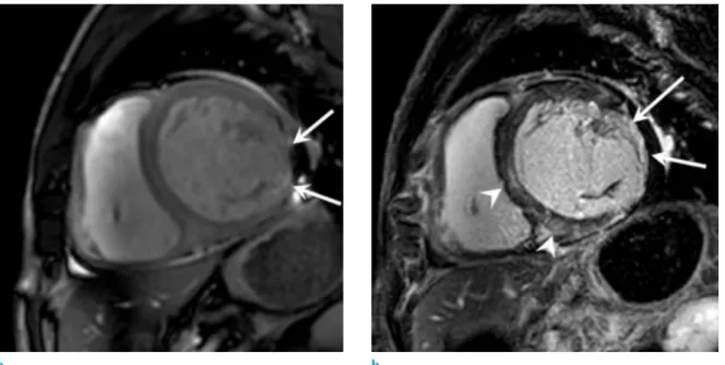 Fig. 2.  Chronic CS in a 74-year-old woman who complained dyspnea. Short-axis SSFP MR cine image (a) shows decreased  wall motion and decreased wall thickness of inferolateral wall (arrows) at the basal LV level