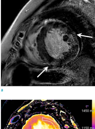 Fig. 3. Suspected CS in a 36-year-old man who  complained orthopnea. Short-axis LGE (a) shows  subtle enhancement at midventricular inferoseptal  wall and anterolateral wall (arrows)