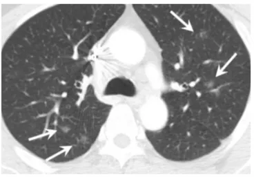 Fig. 4. Multimodality imaging in a 59-year-old woman  with systemic sarcoidosis. Non-ECG gated chest CT images  with mediastinal window setting (a) show enlarged lymph  nodes along the mediastinum (arrowheads) and lung  window setting (b) show scattered se