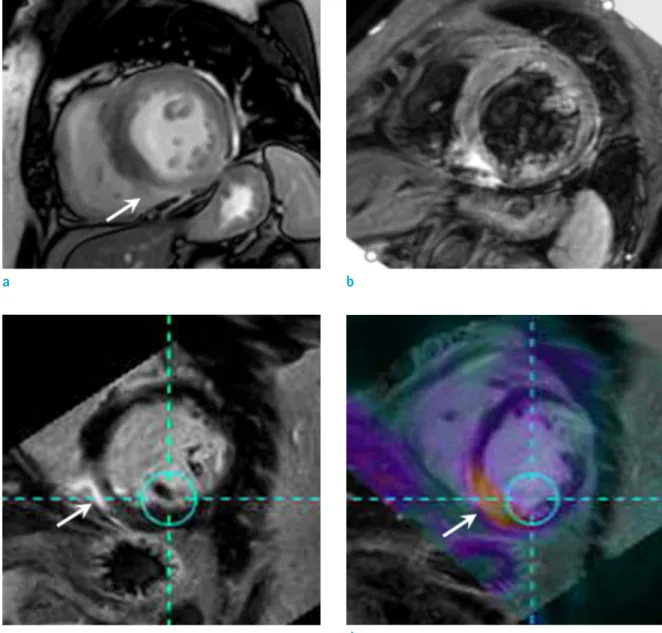 Fig. 5. Conjoined imaging of PET and MR in a 59-year-old woman with cardiac sarcoidosis