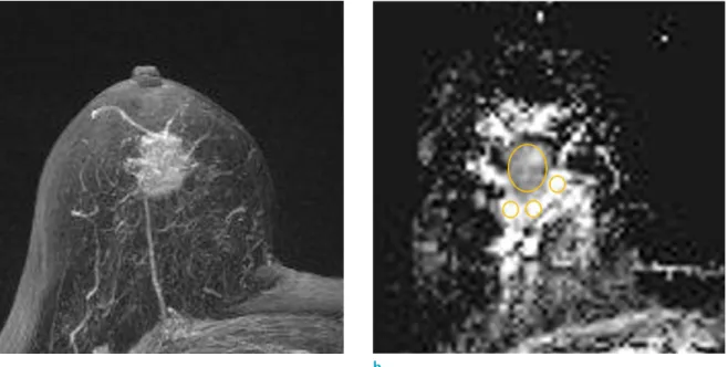 Fig. 1.  Maximum-intensity-projection image (a) and ADC map (b) in a 70-year-old woman with invasive ductal carcinoma,  show the method used for placing ROIs to obtain the tumor ADC, peritumor ADC