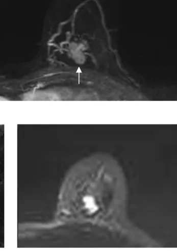 Fig. 2. A 66-year-old woman with palpable mass (arrows)  on the left breast, had pathologically confirmed invasive  ductal carcinoma, with axillary lymph node metastasis  after surgery