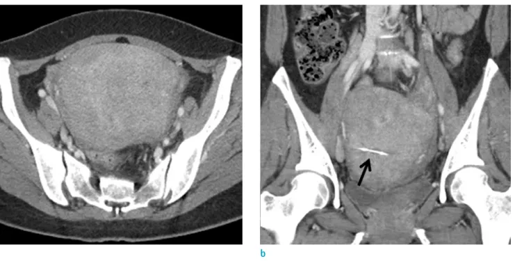 Fig. 1.  A contrast-enhanced abdominal axial (a) and coronal (b) reformatted CT images on initial presentation showed  diffuse enlargement of the uterus with a poorly defined, heterogeneously enhancing lesion