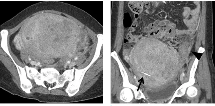 Fig. 2. A follow-up contrast-enhanced abdominal axial (a) and coronal (b) reformatted CT images 3 months after initial  presentation showed enlarged heterogeneously enhancing uterine lesion with multiple focal areas of low-attenuation