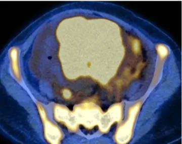 Fig. 5.  On cut sections of the uterine gross specimen (a), a huge  globoid uterine corpus revealed a markedly thickened myometrium  showing multifocal, ill-defined abscesses and pus-like material