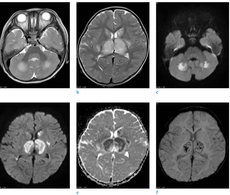 Fig. 1. An 18-month-old girl with a sudden generalized tonic-clonic (GTC) seizure. (a, b) Axial T2 and (c, d) diffusion- diffusion-weighted images show symmetric hyper intense lesions in the bilateral cerebellum, thalami and basal ganglia
