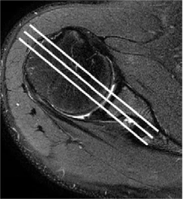 Fig. 1. T2 value measurement (a, b). Three consecutive  oblique coronal sections comprising large areas of humeral  and glenoid cartilage were selected from the images