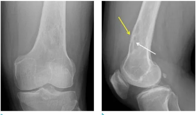 Fig. 1. AP (a) and lateral (b) radiographs of the left knee shows an osteolytic lesion with moth-eaten bone destruction in the  distal diaphysis of the left femur