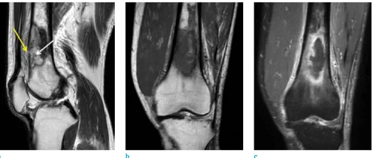 Fig. 2. Sagittal T2-weighted MR image (a) shows cortical perforation suggesting cloaca (yellow arrow) and suspected bony  sequestrum (white arrow) in the distal diaphysis of the left femur