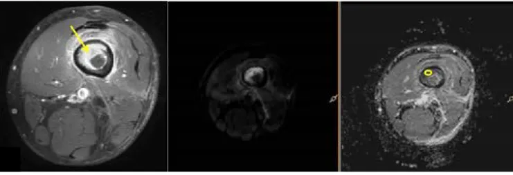 Fig. 4. The measurement of ADC value at b 800 s/mm 2  using axial contrast-enhanced fat-suppressed T1-weighted MR  images, diffusion weighted images (DWI) and apparent diffusion coefficient (ADC) map
